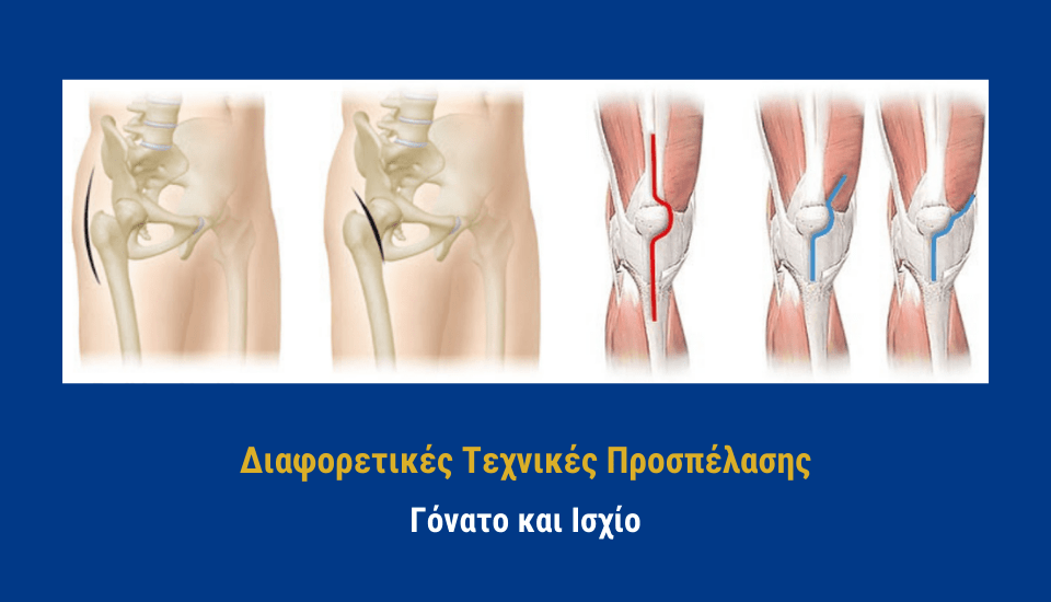 Διαφορετικές Τεχνικές Προσπέλασης σε Γόνατο και Ισχίο (960 x 550 px)